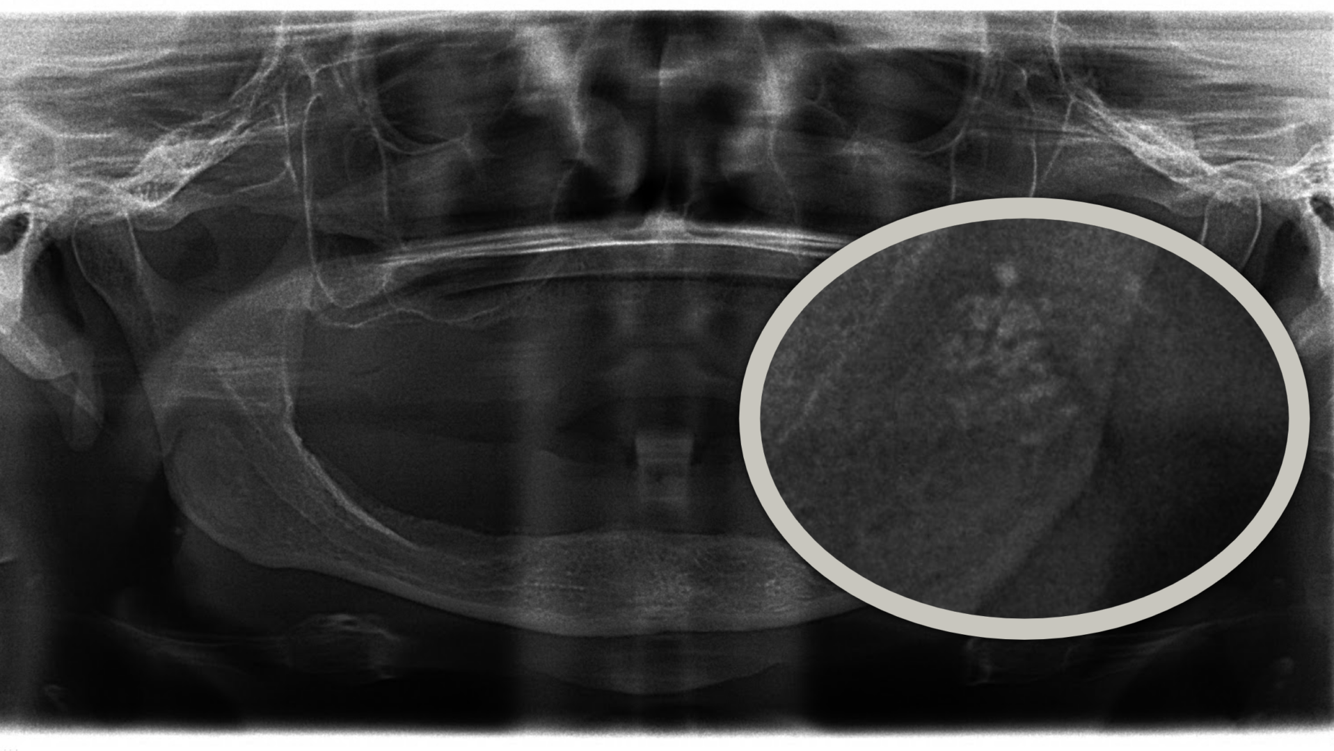 Calcifications/Radiopacities: Case Study | IGNITEDDS