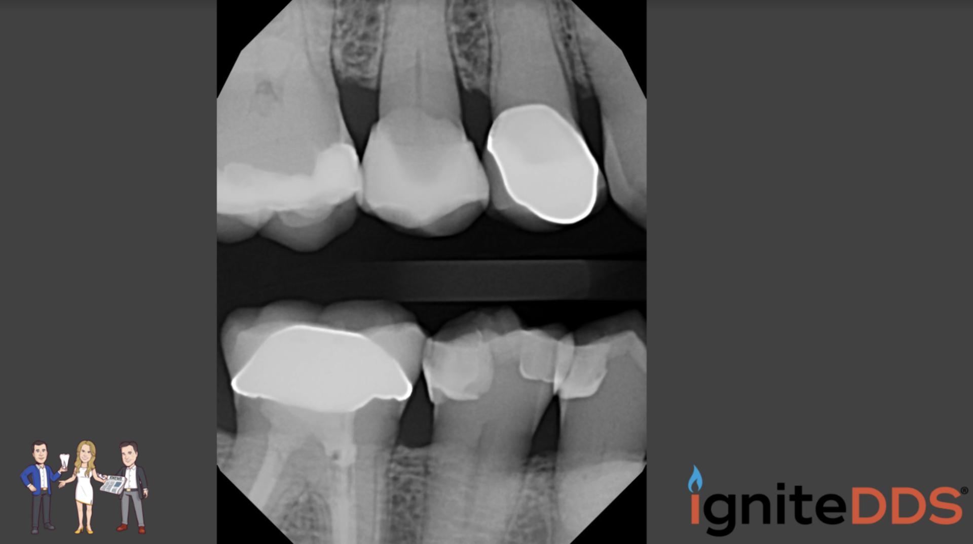 Fractured Tooth Case Study igniteDDS