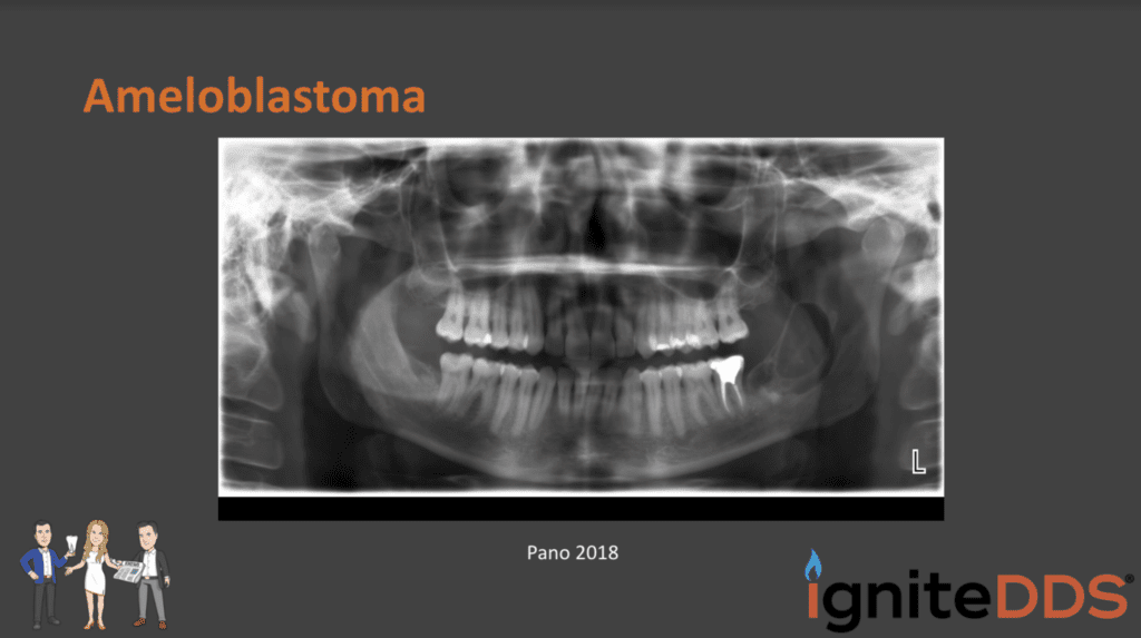 2018 Pano of the Patient with Ameloblastoma