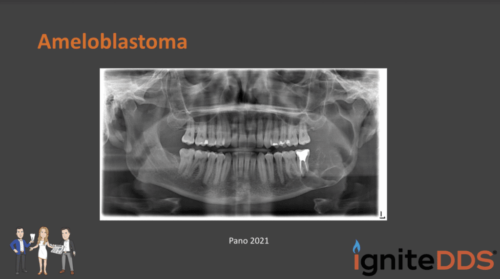 2021 Pano of the Patient with Ameloblastoma