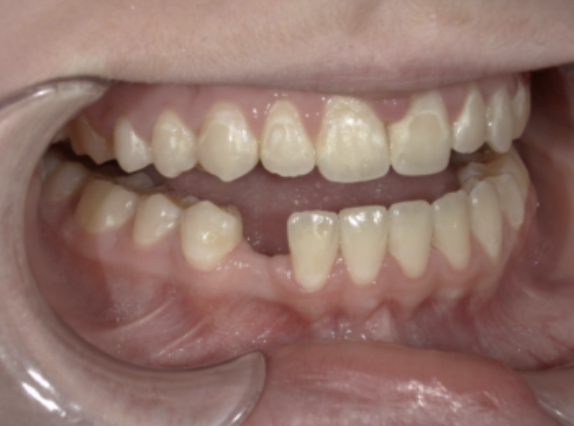 congenitally missing tooth