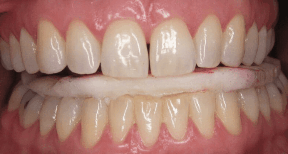 Ignite Splint Splint Therapy: Time Is On Our Side (with Dr. Will Kelly)