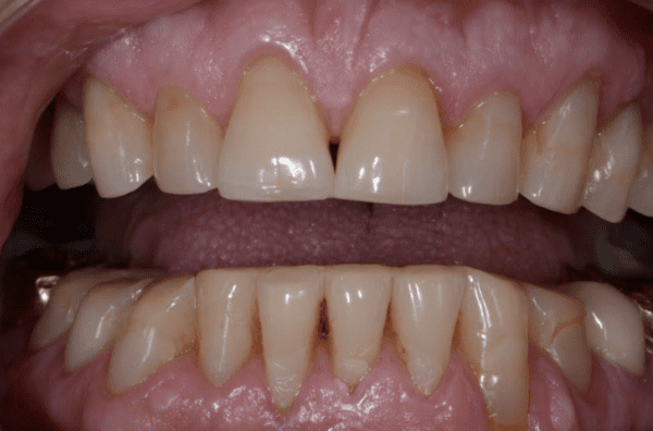 anterior teeth