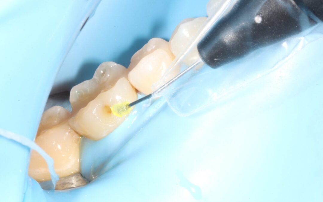 Systems & Simplicity: Two Words that Come to Mind When Working with the Direct Restorative Workflow Kit from Ivoclar