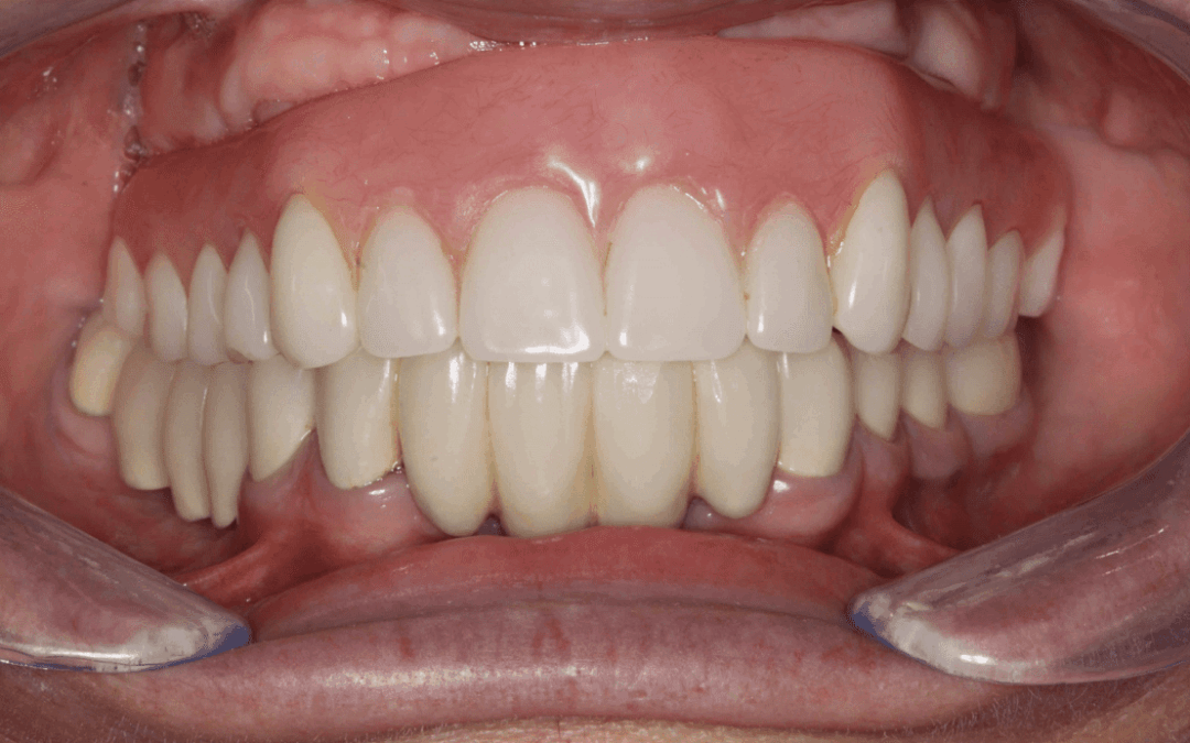 Considerations of Treatment Planning a Maxillary Implant Prosthesis