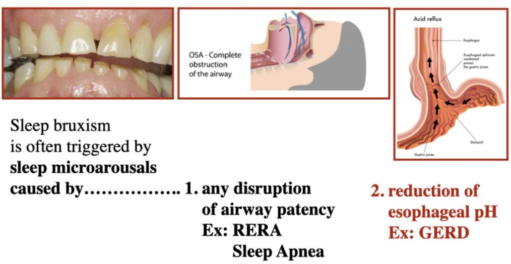 an educational slide of airway dentistry showing effects of sleep apnea