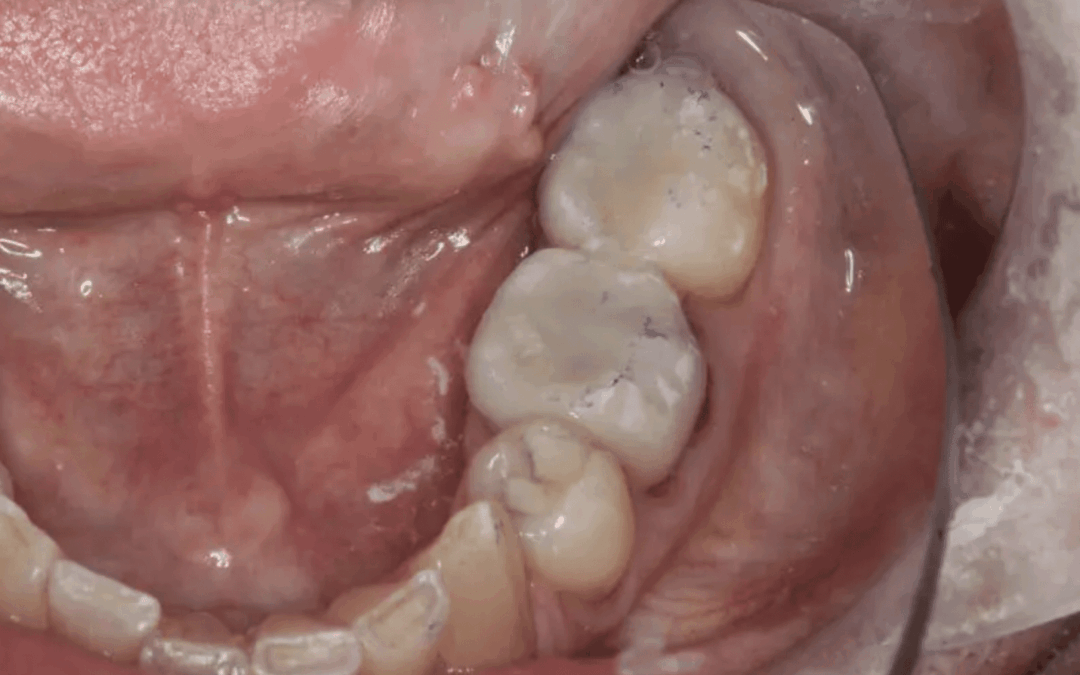 Dentist Education: How Do I Predictably Prep Second Molars?