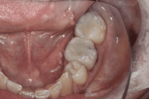 prepping second molars