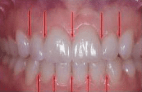 picture of teeth with arrows pointing to the Interdental Papilla
