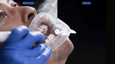 Image of dentist using Vivadent Aerosol Reduction Gel on a patient and the difference with not using it