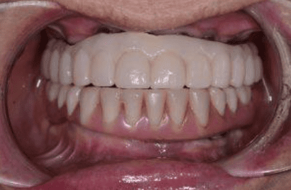 A Challenging Hybrid Overdenture Case