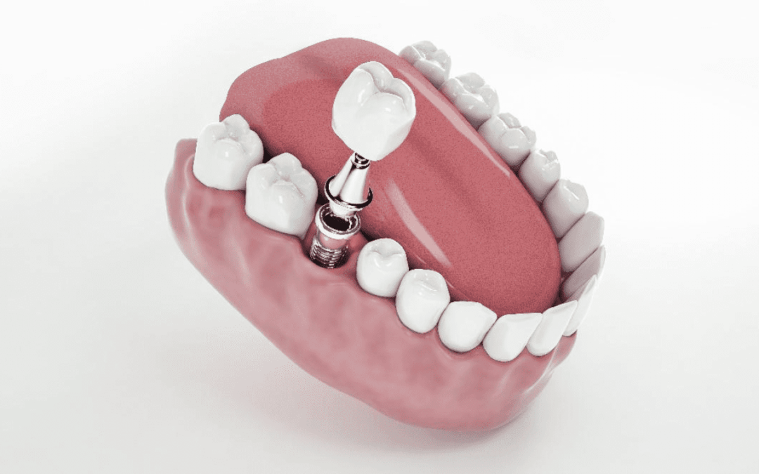 Simple Tip For Cementation of Crowns on Implant Abutments