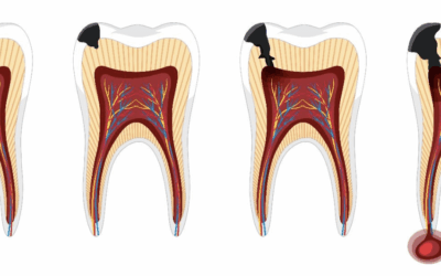 Medications that Interfere with Accurate Endodontic Diagnosis