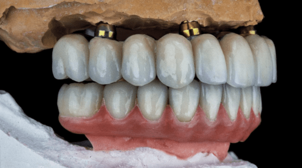 hybrid dentures failure