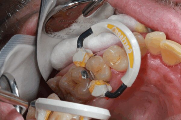 caries on 13D, restored with garrison matrix and ecosite elements