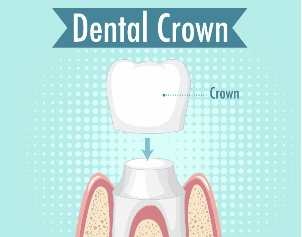 Removing Dental Cement Inside A Zirconia And Lithium Disilicate Crown