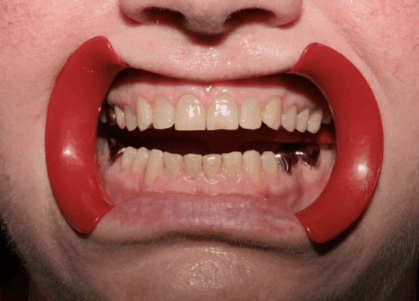 worn teeth