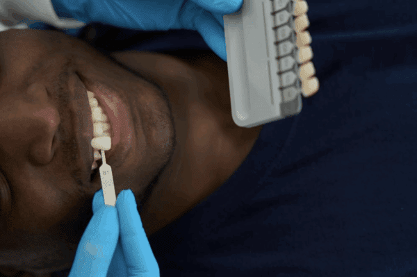 A Conservative Approach for Missing Lateral Incisors