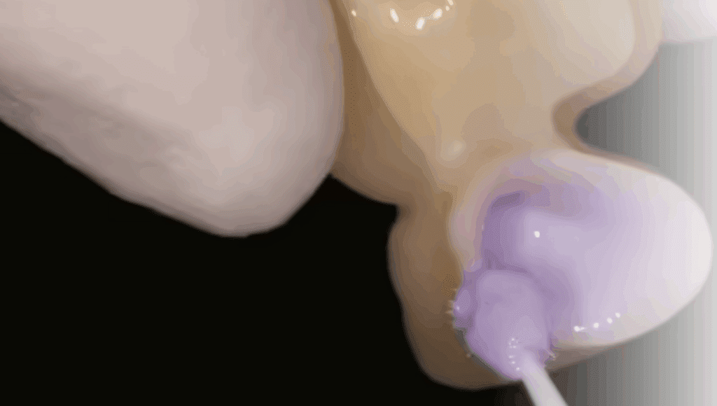 Removing Saliva Contamination Effectively from Indirect Restorations