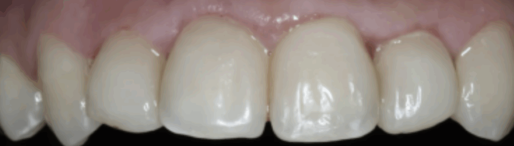 composite veneers