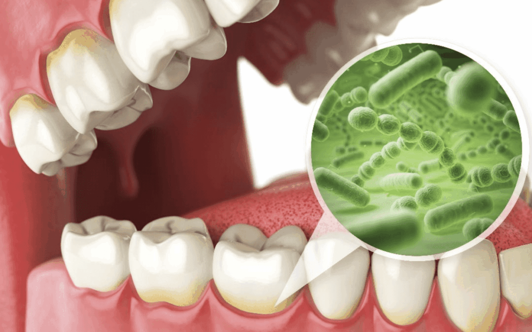 Transforming Professional Teeth Cleanings with Guided Biofilm Therapy