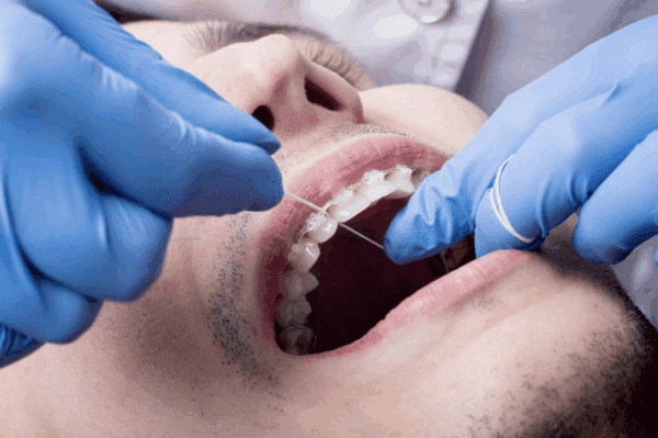 ideal floss for dental implant care