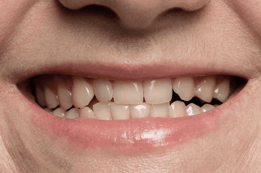 correcting patients' S sound during restorative dental treatment