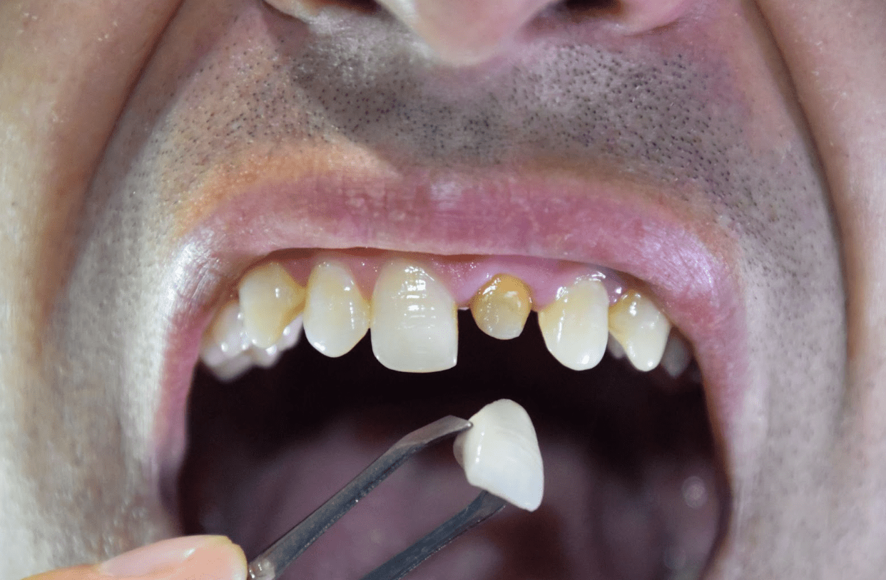 Keeping Gingival Crevice Healthy