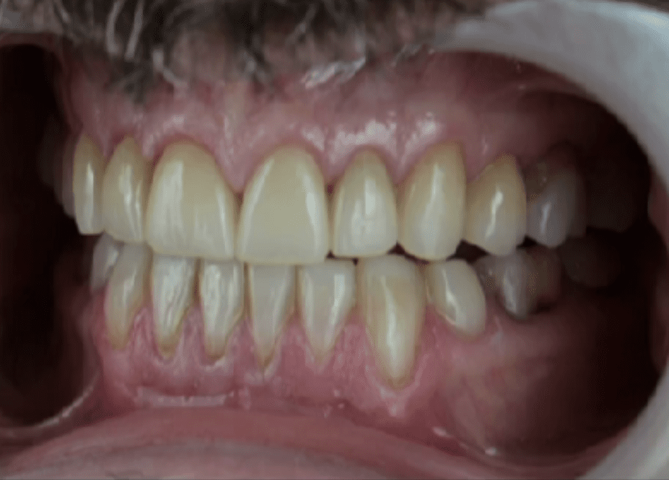 Beautiful Smile Design Case using a Fully Digital Workflow