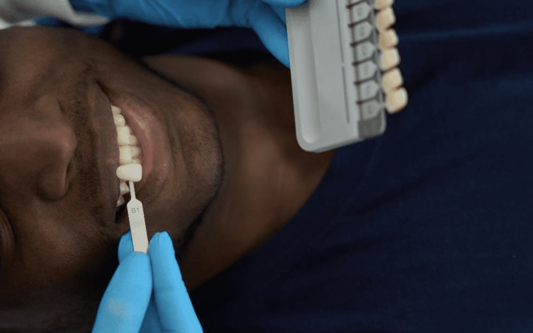 Resin-Bonded Bridges: A Conservative Approach for Missing Lateral Incisors