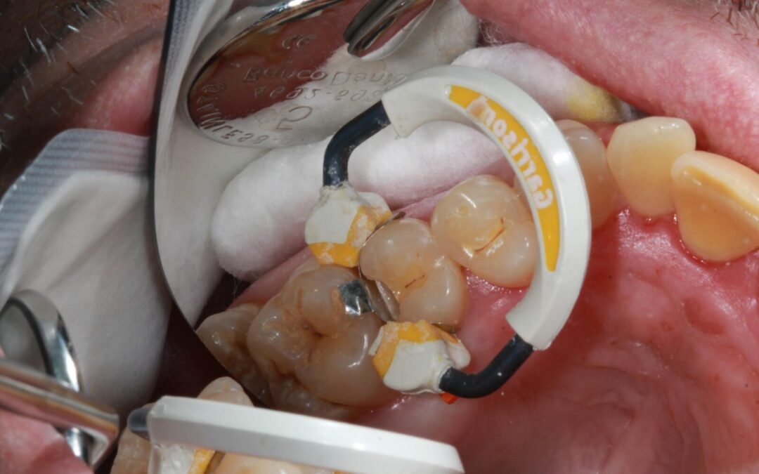Caries on #13D: Restored with Garrison Matrix System & Ecosite Elements