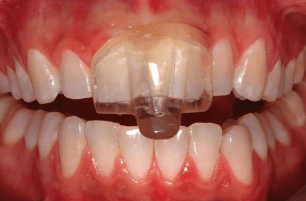 Anterior-Deprogramming-Device