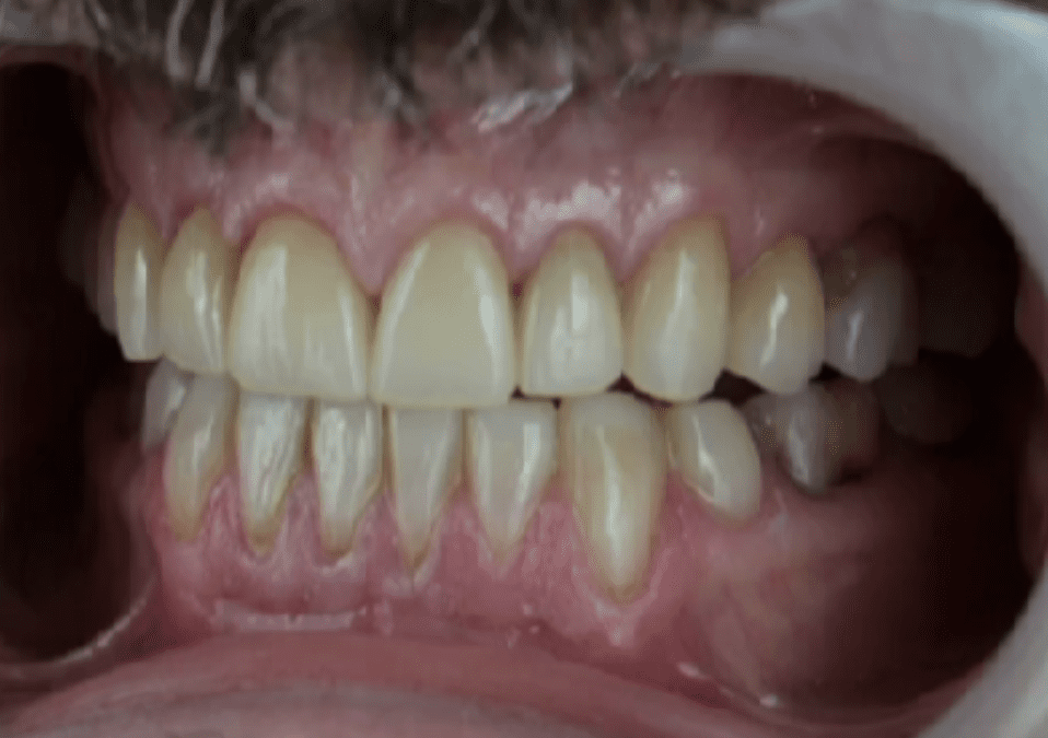Beautiful Smile Design Case using a Fully Digital Workflow