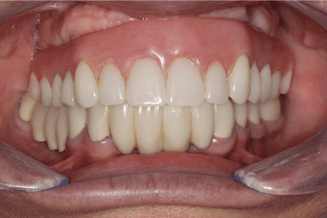 Fixed-Implant-Bridge