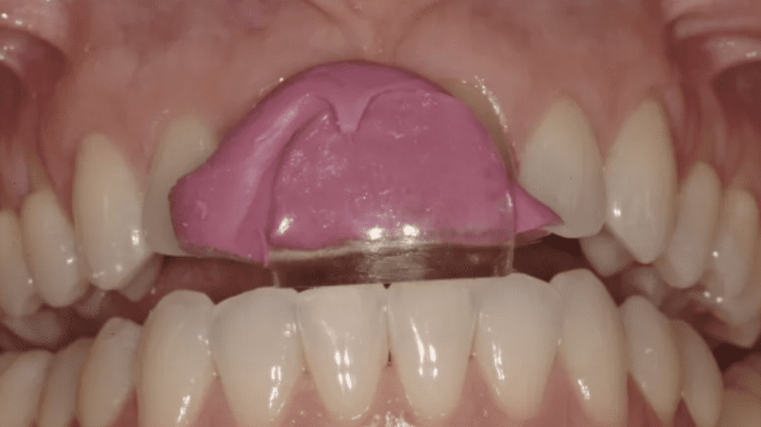 My Favorite Occlusal Deprogrammers