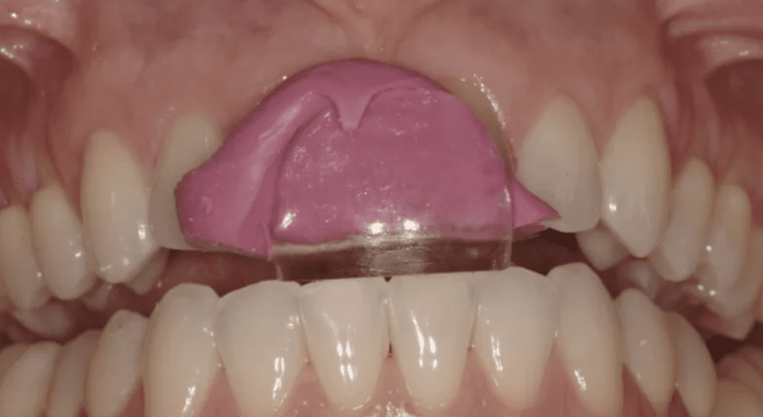 My-Favorite-Occlusal-Deprogrammers