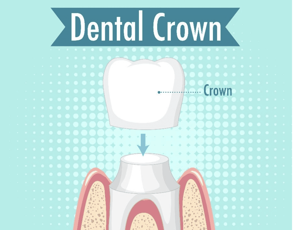 Removing-Dental-Cement-Inside-A-Zirconia-And-Lithium-Disilicate-Crown