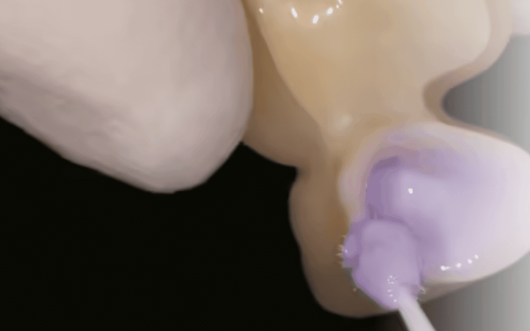 Removing Saliva Contamination Effectively from Indirect Restorations