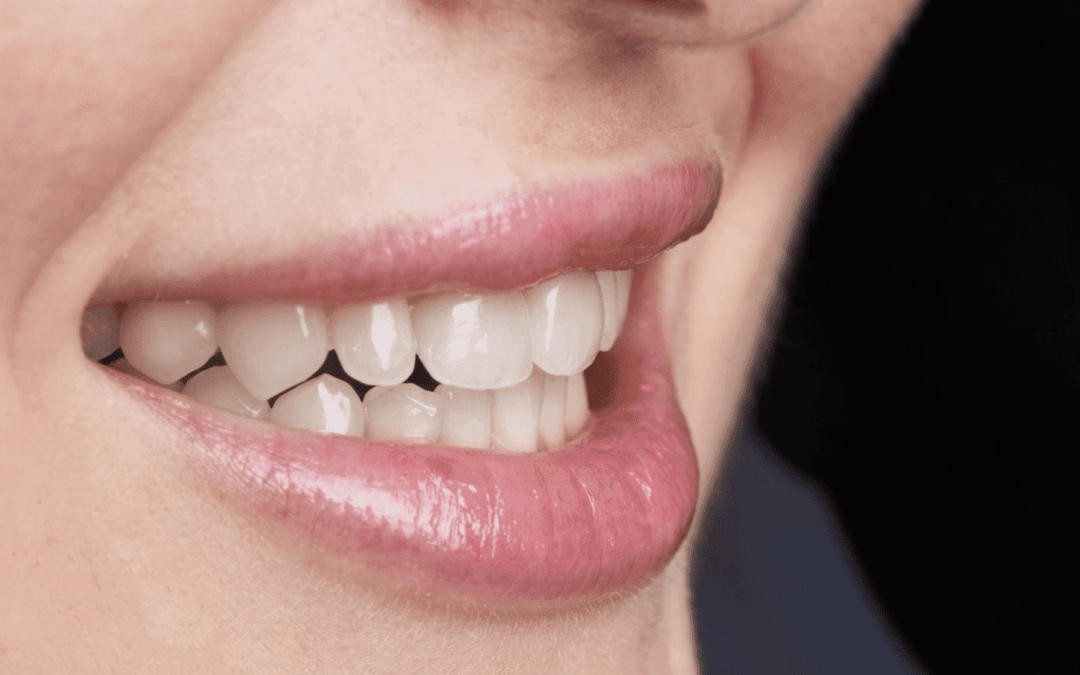 Restoring Undersized & Peg Laterals: No Tooth Prep Needed