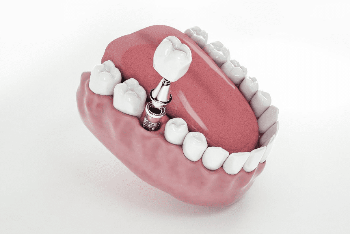 Simple-Tip-For-Cementation-of-Crowns-on-Implant-Abutments