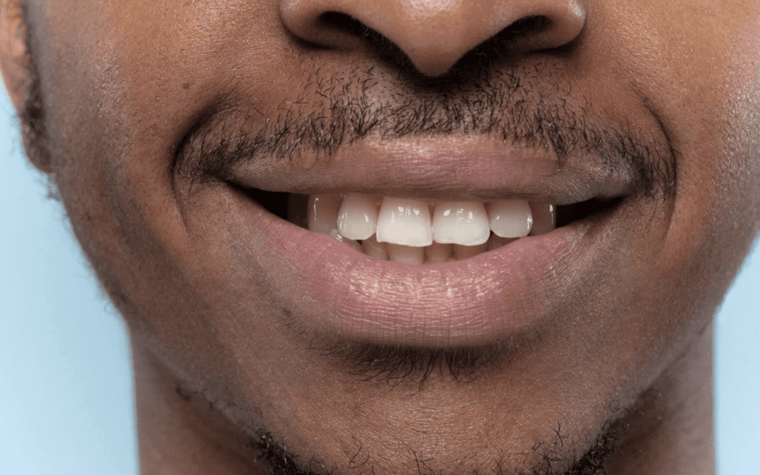 The Index Technique: New No-Prep Approach for Worn Dentition