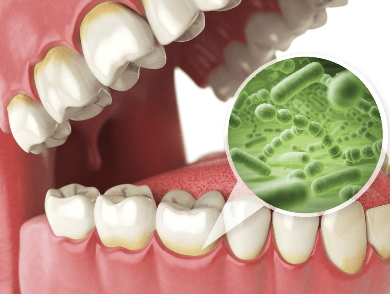 Transforming-Professional-Teeth-Cleanings-with-Guided-Biofilm-Therapy