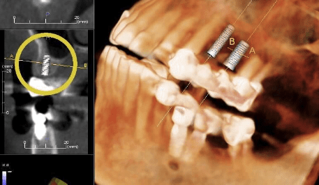 adult-growth-of-the-dental-arch