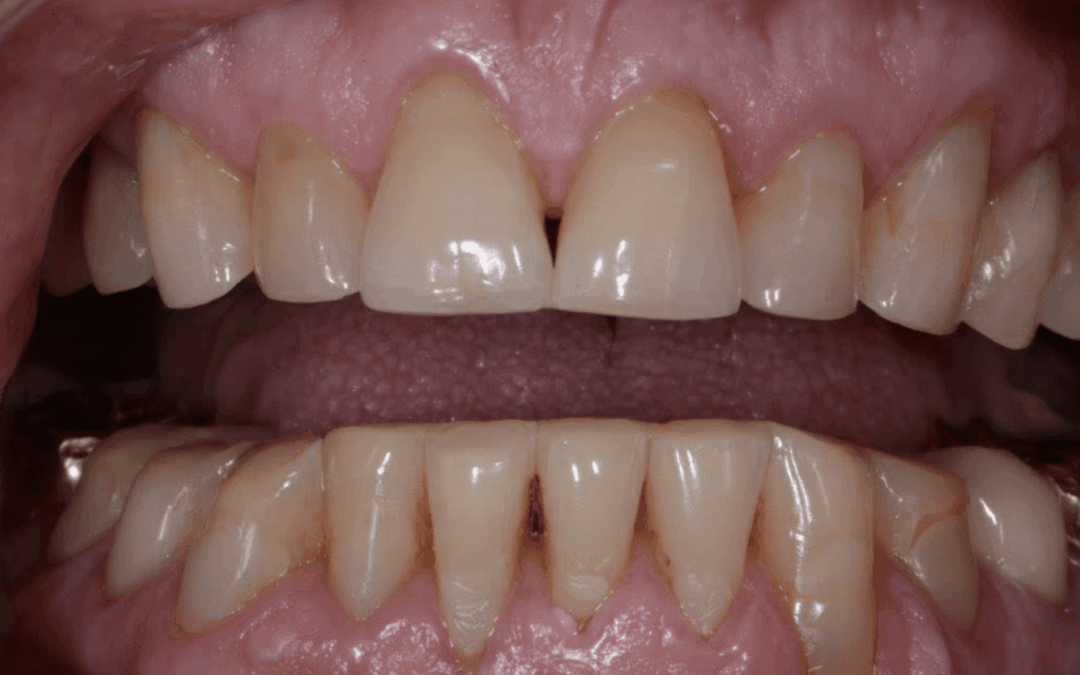 Why Do I Keep Having to Adjust the Anterior Teeth When Restoring?