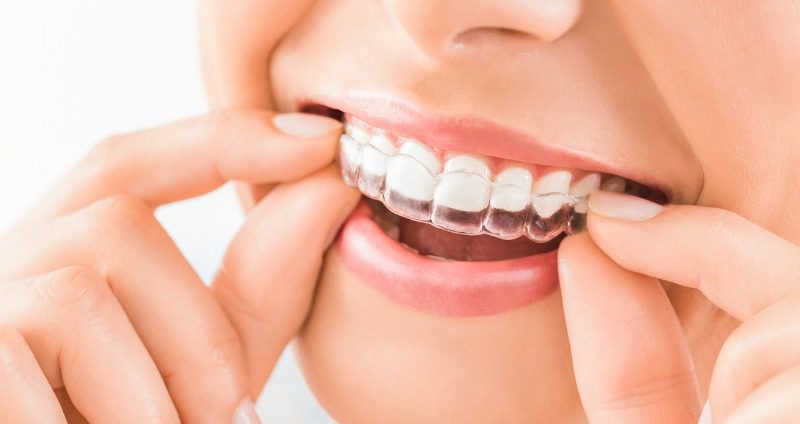 clear-retainers
