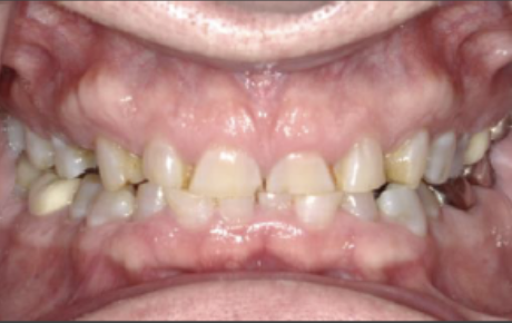 erosive-tooth-lesions