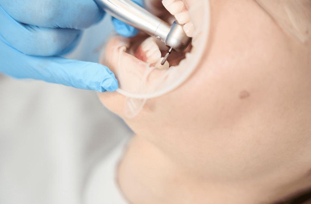 Evaluating Crown Integrity After Endodontic Access Preparation