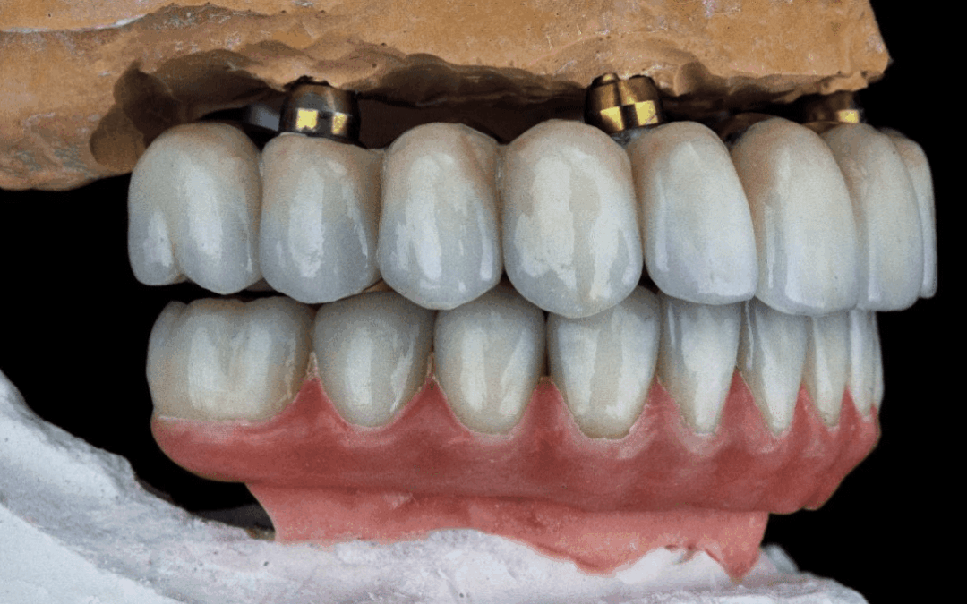 Hybrid Dentures: When Their Lifespan Runs Out