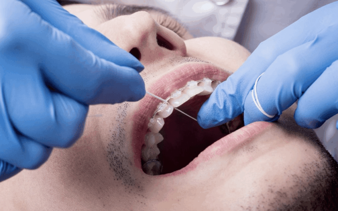 The Ideal Floss for Dental Implant Care