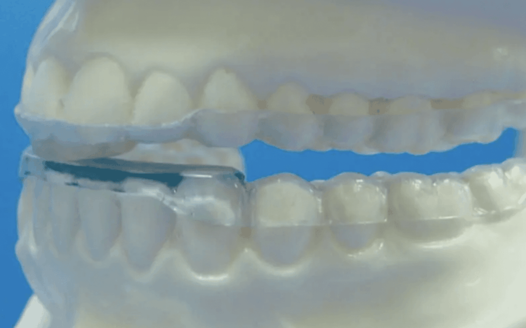 Q&A with Dr. Hess: Patients Who Have More Pain After Wearing a B-Splint